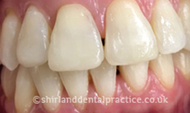 After - Shirland Dental