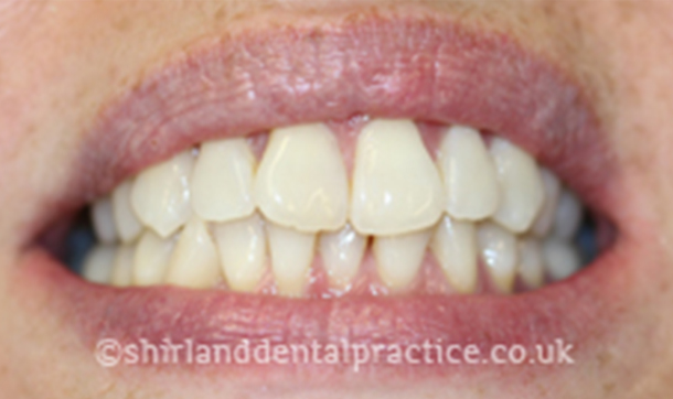 Before - Shirland Dental