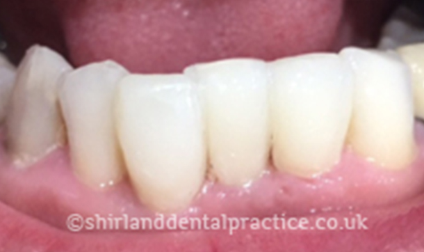 After - Shirland Dental