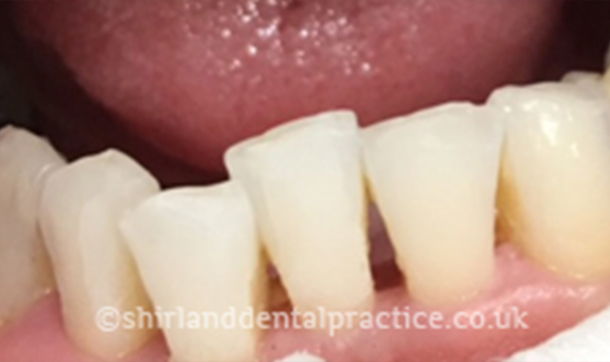 Before - Shirland Dental