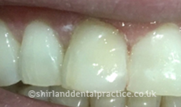 After - Shirland Dental