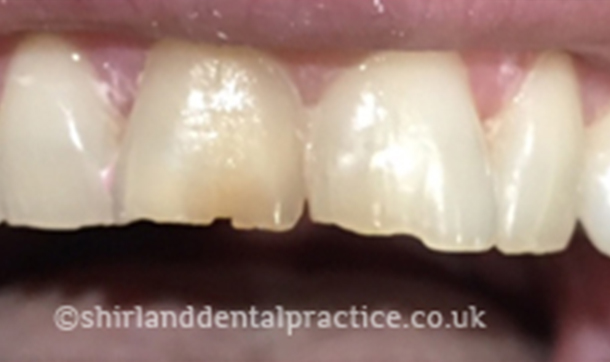 Before - Shirland Dental