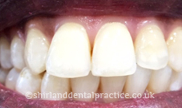 After - Shirland Dental