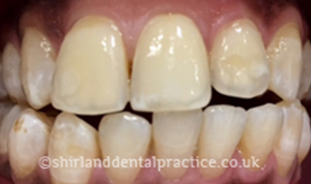 Before - Shirland Dental