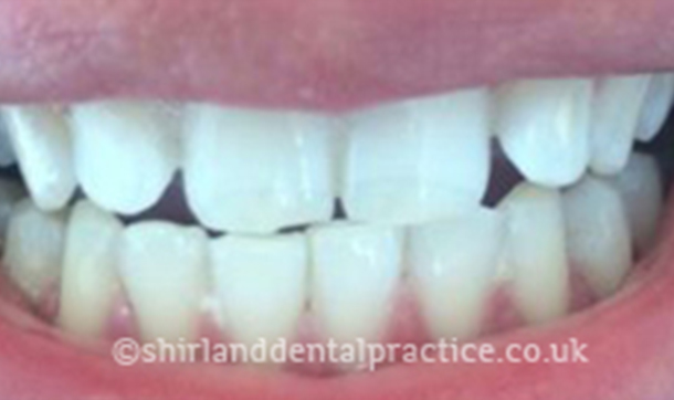 After - Shirland Dental