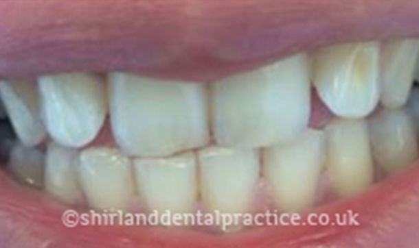 Before - Shirland Dental