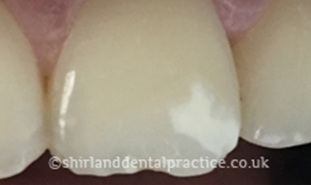 Before - Shirland Dental