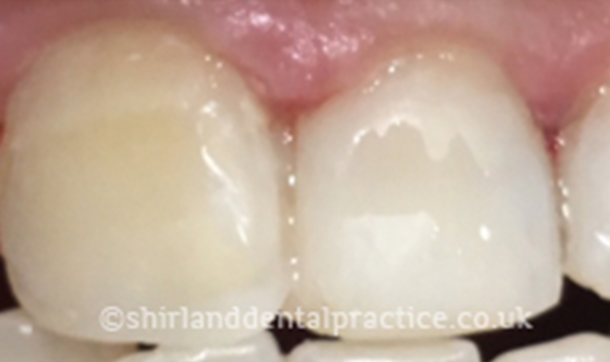 After - Shirland Dental