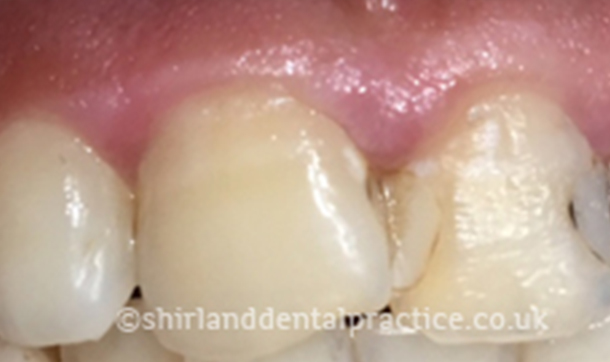 Before - Shirland Dental