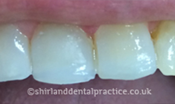 After - Shirland Dental
