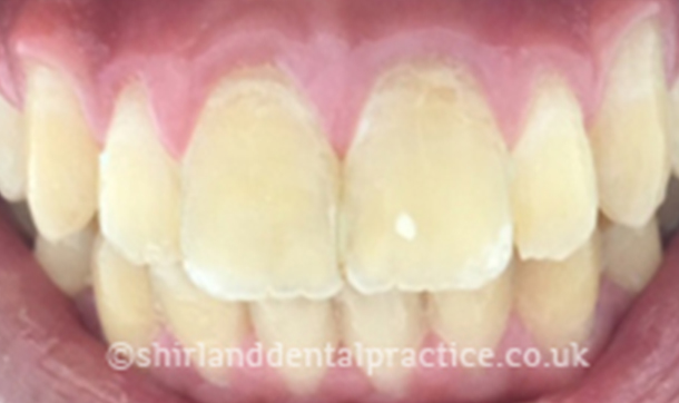 After - Shirland Dental