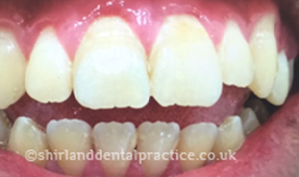 Before - Shirland Dental