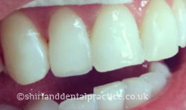 After - Shirland Dental