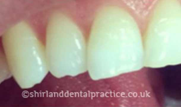 Before - Shirland Dental