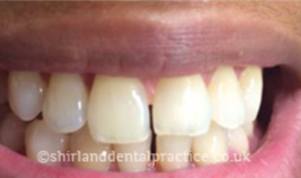 Before - Shirland Dental