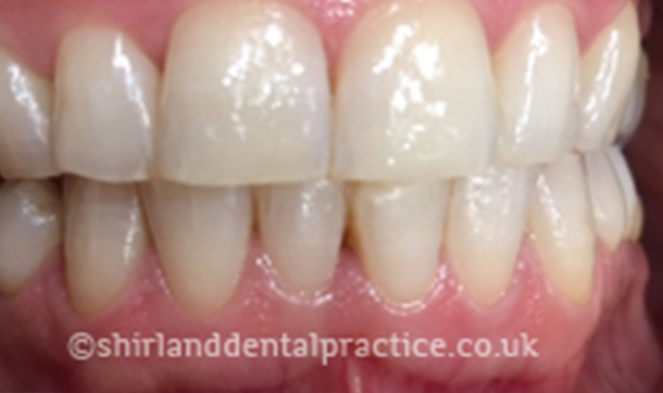 After - Shirland Dental