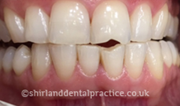Before - Shirland Dental