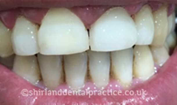 After - Shirland Dental