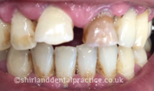 Before - Shirland Dental