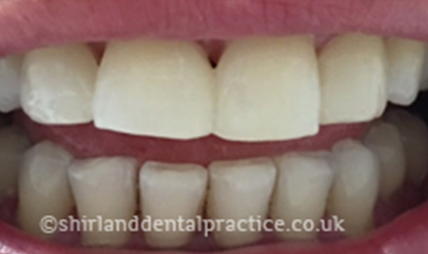 After - Shirland Dental