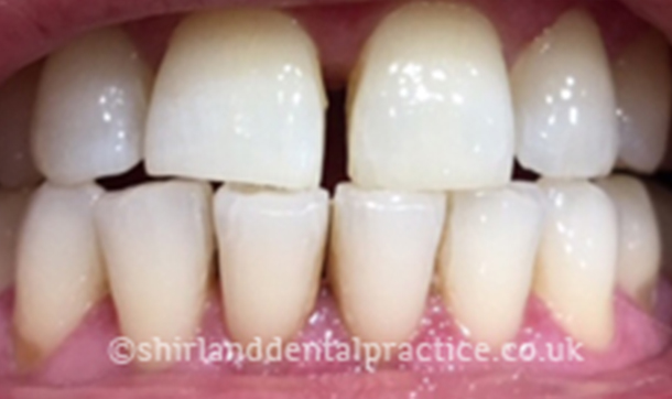 Before - Shirland Dental