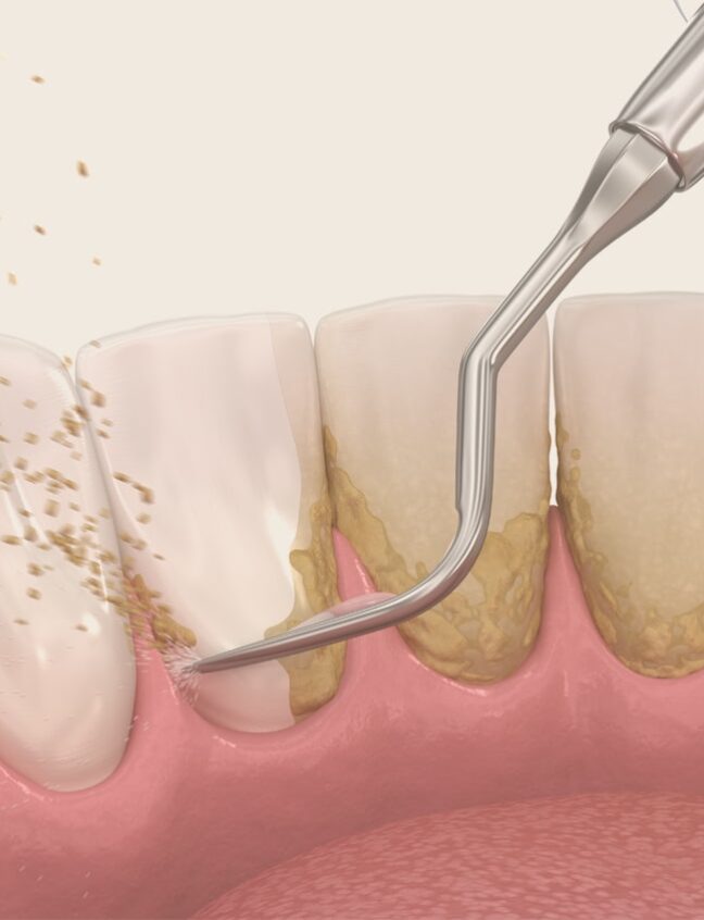 Treatment - Shirland Dental